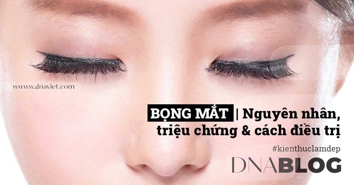 Bọng mắt - Nguyên nhân, triệu chứng & cách điều trị