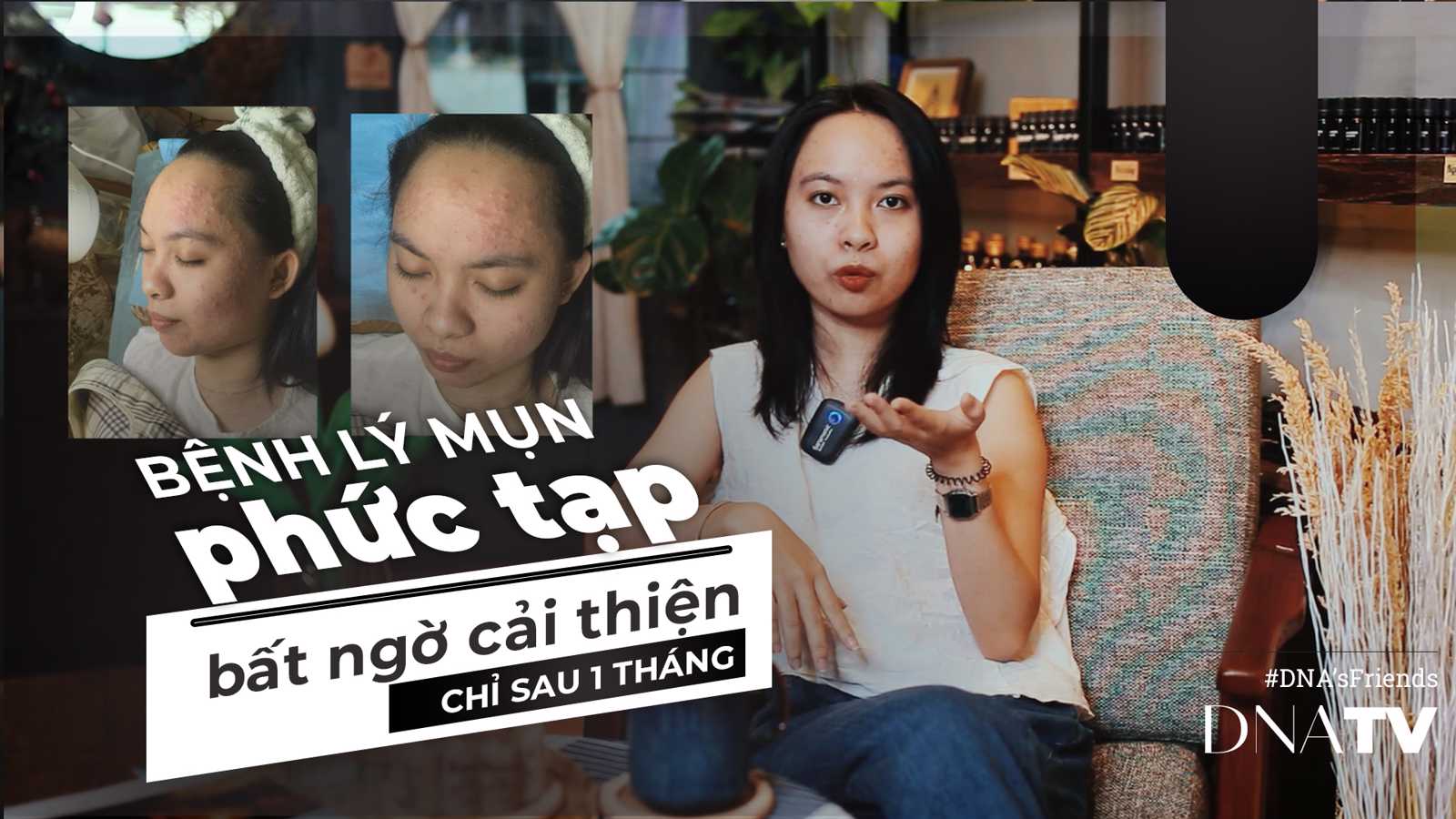 Công nghệ Tế bào gốc giúp Ms An cải thiện tình trạng da mụn nặng chỉ sau 1 tháng